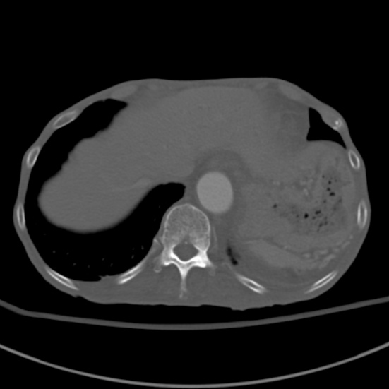 Aortic aneurysm with spinal destruction (Radiopaedia 42301-45410 Axial bone window 13).jpg