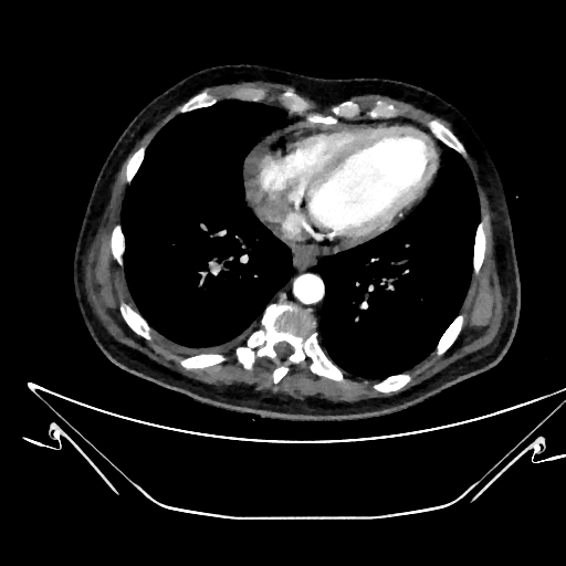 Aortic arch aneurysm (Radiopaedia 84109-99365 C 323).jpg
