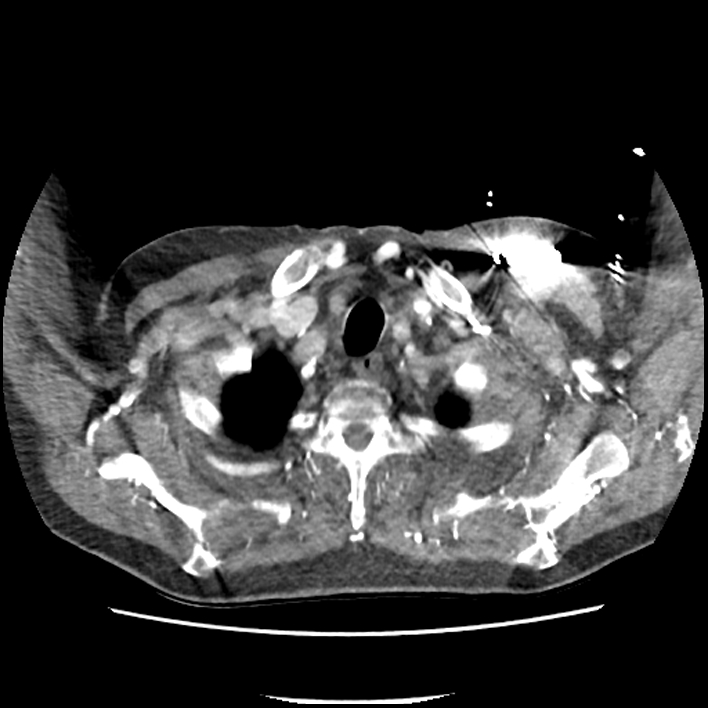 Aortic arch graft infection (FDG PET-CT) (Radiopaedia 71975-82437 A 3).jpg