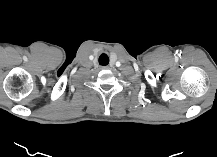 File:Aortic coarctation with aneurysm (Radiopaedia 74818-85828 A 189).jpg