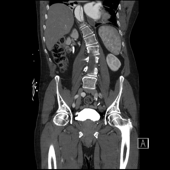 File:Aortic dissection (CTPA) (Radiopaedia 75506-86750 F 44).jpg