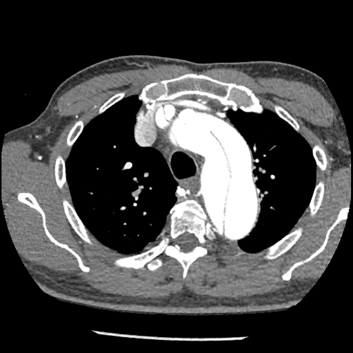 Aortic dissection - DeBakey Type I-Stanford A (Radiopaedia 79863-93115 A 9).jpg
