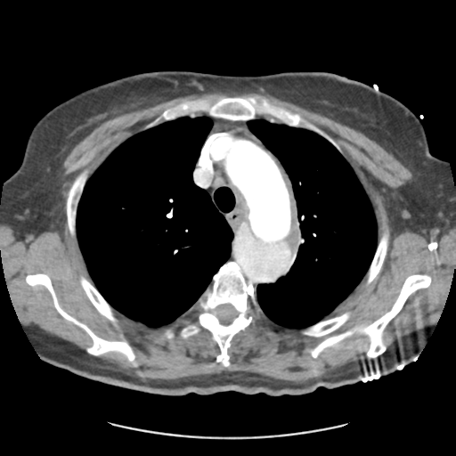 File:Aortic dissection - Stanford type B (Radiopaedia 50171-55512 A 13).png