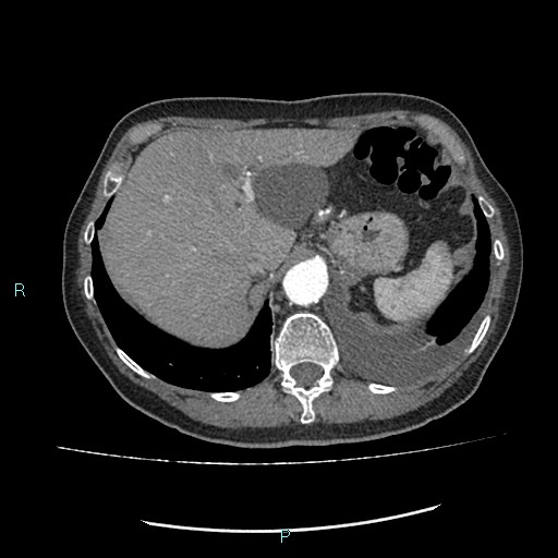 File:Aortic dissection extended to lusory artery (Radiopaedia 43686-47136 B 13).jpg