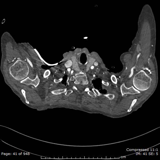 File:Aortic dissection with extension into aortic arch branches (Radiopaedia 64402-73204 B 41).jpg