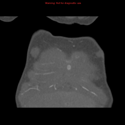 File:Aortic ductus diverticulum (Radiopaedia 8339-9180 B 9).jpg