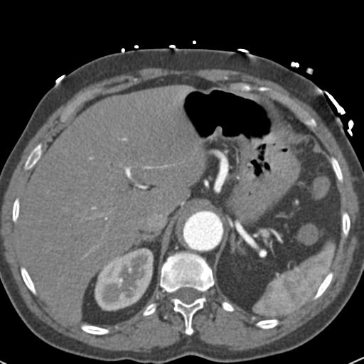 Aortic intramural hematoma (Radiopaedia 31139-31838 B 82).jpg