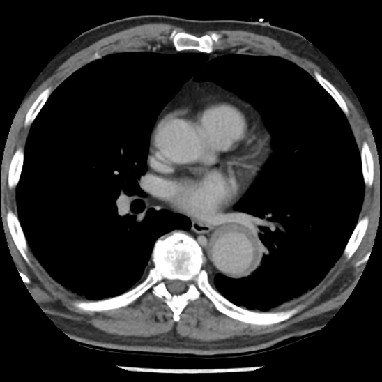 File:Aortic intramural hematoma (type B) (Radiopaedia 79323-92387 Axial C+ delayed 29).jpg