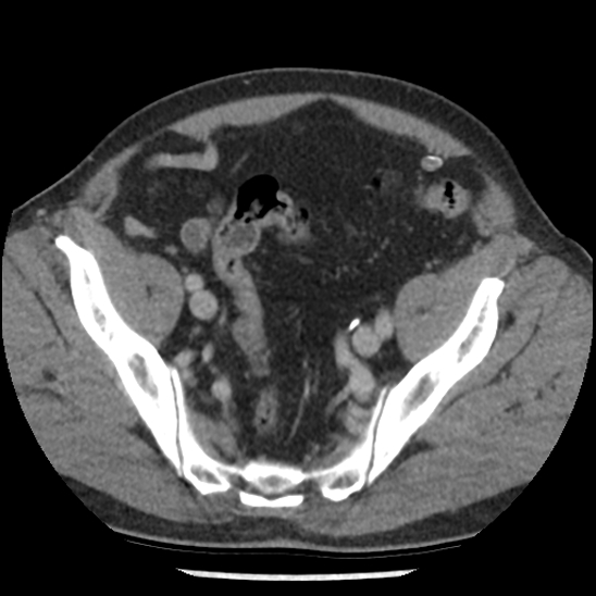 File:Aortic intramural hematoma (type B) (Radiopaedia 79323-92387 Axial C+ delayed 99).jpg
