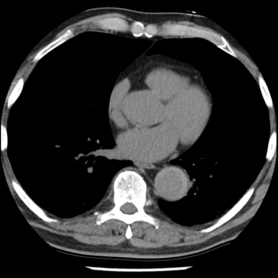 Aortic intramural hematoma (type B) (Radiopaedia 79323-92387 Axial non-contrast 32).jpg