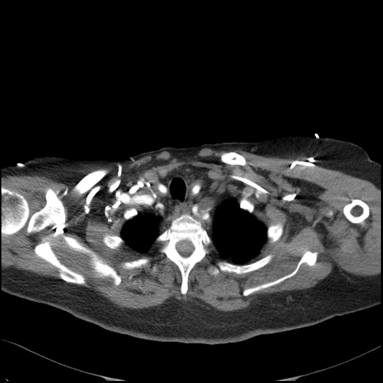 Aortic intramural hematoma with dissection and intramural blood pool (Radiopaedia 77373-89491 B 28).jpg