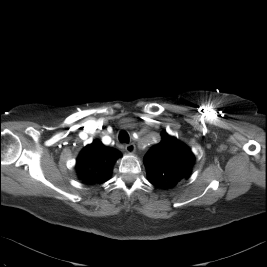File:Aortic intramural hematoma with dissection and intramural blood pool (Radiopaedia 77373-89491 B 31).jpg