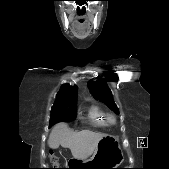 Aortic intramural hematoma with dissection and intramural blood pool (Radiopaedia 77373-89491 C 9).jpg