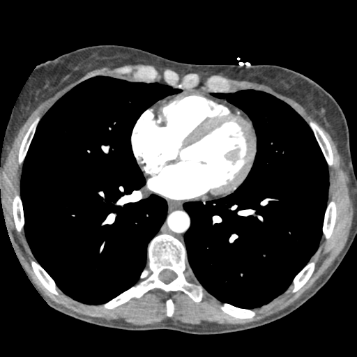File:Aortic valve non-coronary cusp thrombus (Radiopaedia 55661-62189 A 48).png