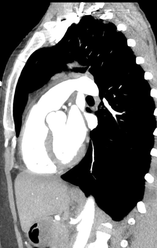 Aortic valve non-coronary cusp thrombus (Radiopaedia 55661-62189 C+ arterial phase 23).png