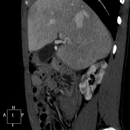 File:Aorto-left renal vein fistula (Radiopaedia 45534-49628 C 6).jpg