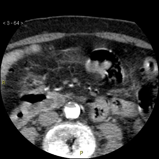 File:Aortoiliac occlusive disease (Radiopaedia 16828-16548 A 64).jpg