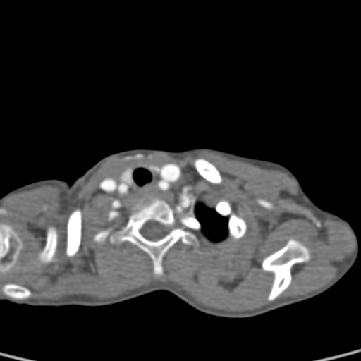 File:Aortopulmonary window, interrupted aortic arch and large PDA giving the descending aorta (Radiopaedia 35573-37074 B 4).jpg