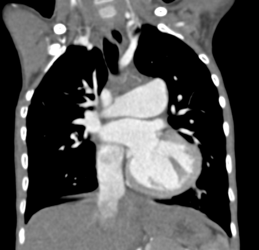 File:Aortopulmonary window, interrupted aortic arch and large PDA giving the descending aorta (Radiopaedia 35573-37074 D 33).jpg