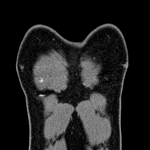 File:Apical lung mass mimic - neurogenic tumor (Radiopaedia 59918-67521 B 30).jpg