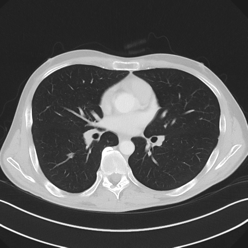 Apical pleural calcification (Radiopaedia 46141-50499 Axial lung window 36).png
