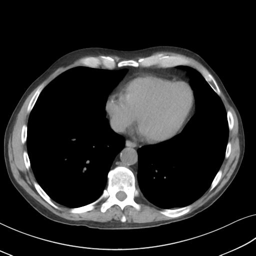 Apical pulmonary metastasis (Radiopaedia 46338-50754 B 45).png