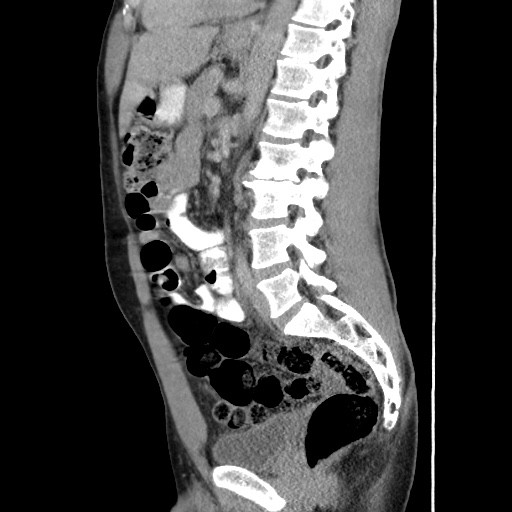 Appendicitis complicated by post-operative collection (Radiopaedia 35595-37114 C 41).jpg