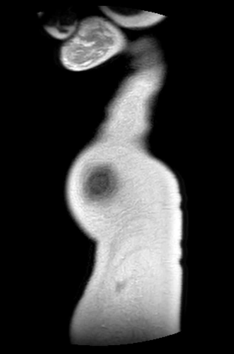 Appendicitis in gravida (MRI) (Radiopaedia 89433-106395 Sagittal T2 2).jpg