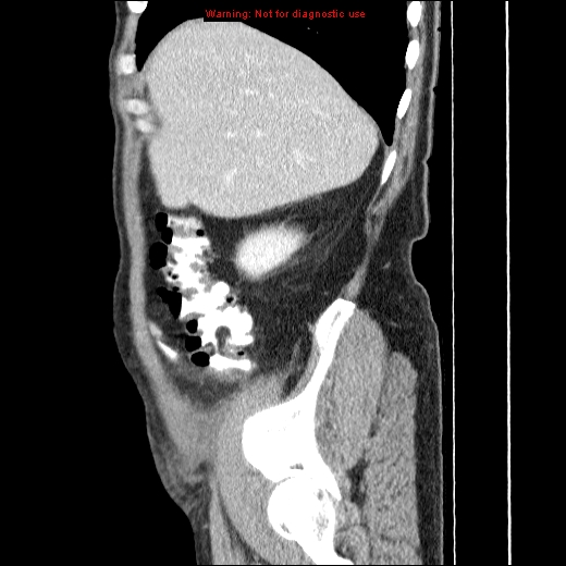 File:Appendicitis mass in inguinal hernia (Radiopaedia 26858-27029 C 8).jpg