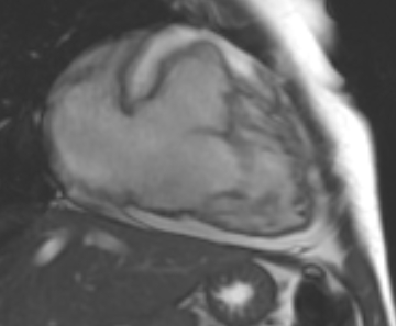 Arrhythmogenic right ventricular cardiomyopathy (Radiopaedia 69431-79307 2ch cine 54).jpg