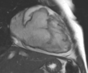 File:Arrhythmogenic right ventricular cardiomyopathy (Radiopaedia 69431-79307 2ch cine 57).jpg