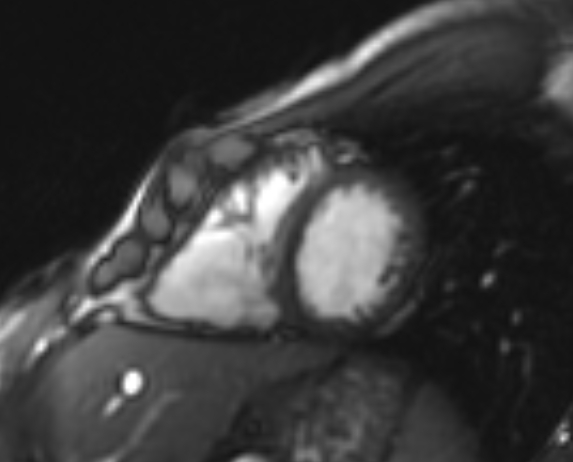 Arrhythmogenic right ventricular cardiomyopathy (Radiopaedia 69564-79464 short axis cine 94).jpg