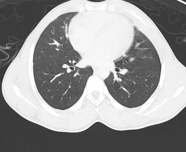 Arrow injury to the chest (Radiopaedia 75223-86321 Axial lung window 47).jpg