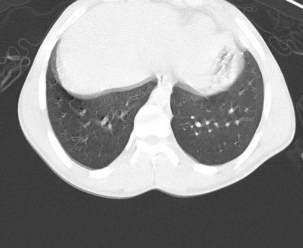 File:Arrow injury to the chest (Radiopaedia 75223-86321 Axial lung window 77).jpg