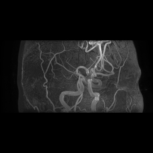 Arteriovenous malformation (Radiopaedia 71628-81999 Axial MRA 15).jpg