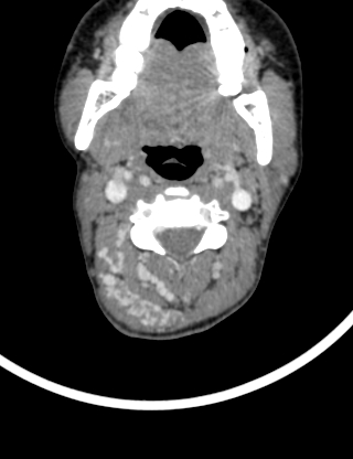 File:Arteriovenous malformation of the neck (Radiopaedia 53935-60062 B 16).jpg