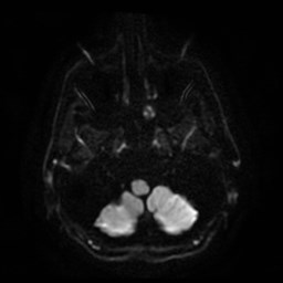 File:Artery of Percheron infarct (Radiopaedia 48088-52928 Axial DWI 5).jpg