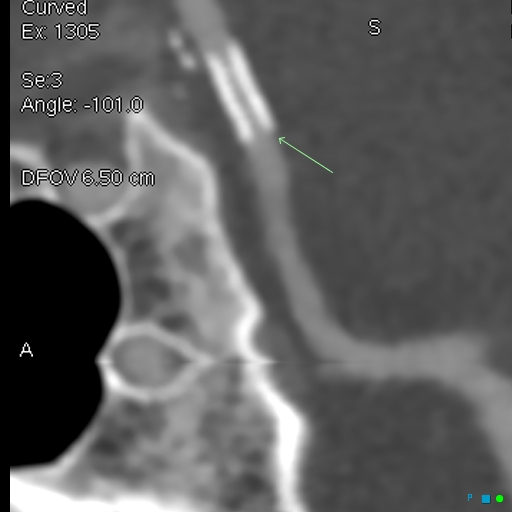 File:Artifactual basilar artery stenosis due to metallic stent (Radiopaedia 31206-31923 B 1).jpg
