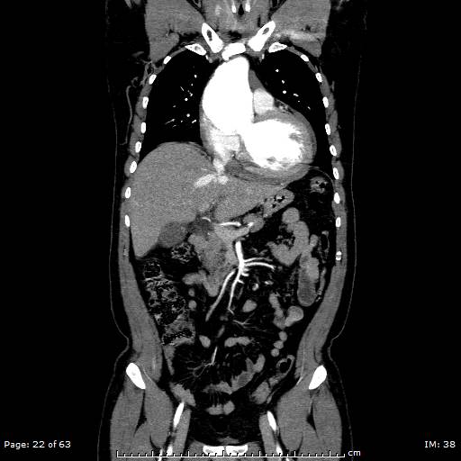 Ascending aortic aneurysm (Radiopaedia 50086-55404 B 22).jpg