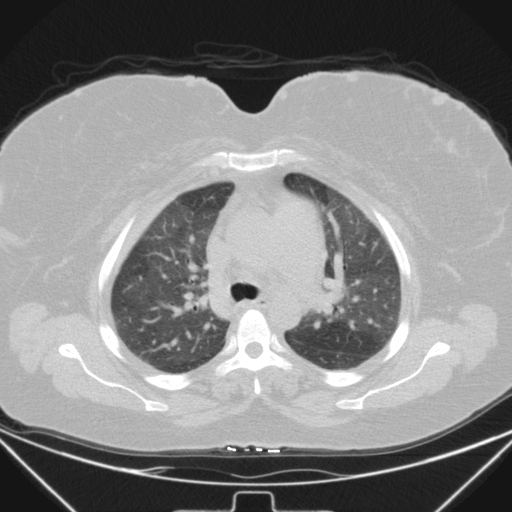 Aspergilloma (Radiopaedia 39611-41932 Axial lung window 41).jpg