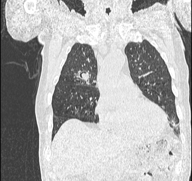 Aspergilloma (Radiopaedia 44592-48327 Coronal lung window 35).jpg