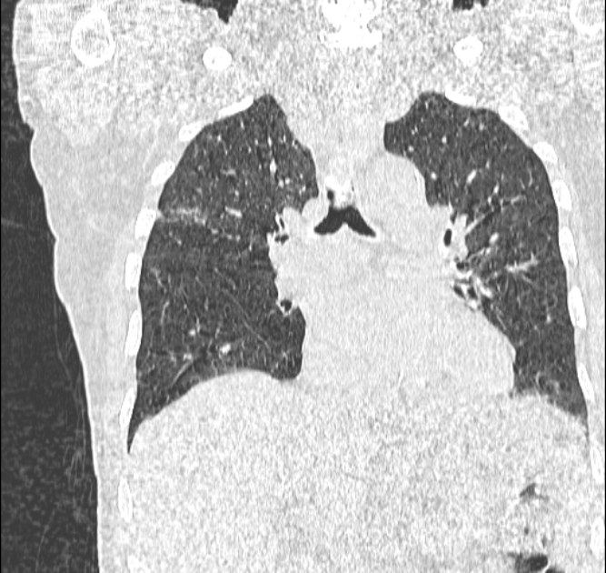 Aspergilloma (Radiopaedia 44592-48327 Coronal lung window 63).jpg
