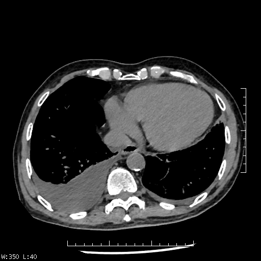 File:Aspergilloma (Radiopaedia 75184-86270 Axial liver window 33).jpg