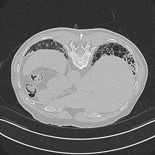 File:Aspergilloma on background pulmonary fibrosis (Radiopaedia 60942-68757 Axial lung window 31).jpg