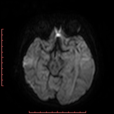 Astroblastoma (Radiopaedia 74287-85162 Axial DWI 39).jpg