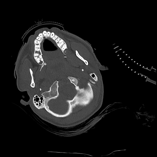 Atlanto-occipital dissociation (Traynelis type 1), C2 teardrop fracture, C6-7 facet joint dislocation (Radiopaedia 87655-104061 Axial bone window 14).jpg