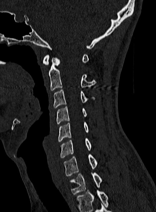 Atlantoaxial subluxation (Radiopaedia 44681-48450 Sagittal bone window 60).jpg