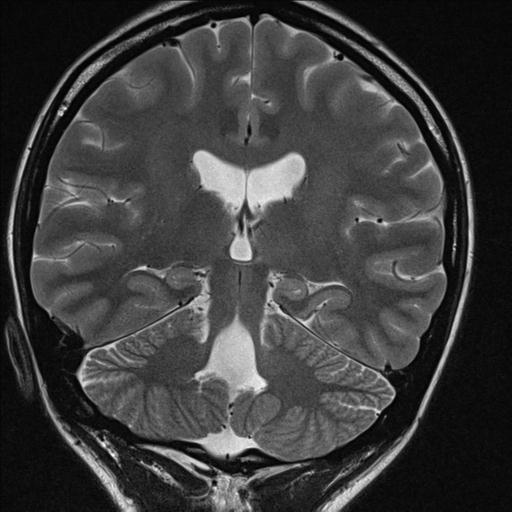 File:Atretic encephalocoele with inferior vermis hypoplasia (Radiopaedia 30443-31108 Coronal T2 2).jpg