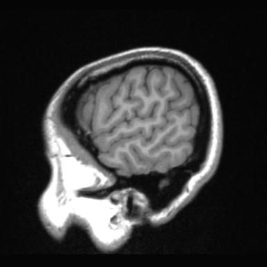 Atretic encephalocoele with inferior vermis hypoplasia (Radiopaedia 30443-31108 Sagittal T1 12).jpg