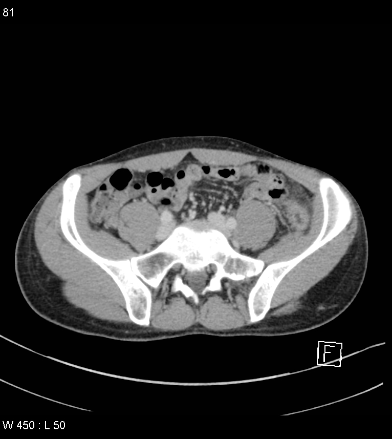 Atypical acute epiploic appendagitis (Radiopaedia 55479-61943 A 80).jpg